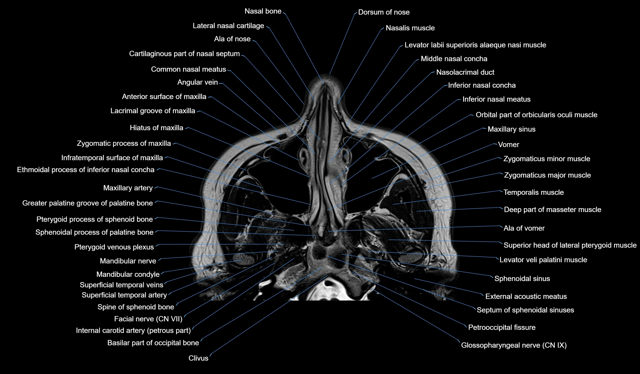 MRI face & paranasal sinuses(PNS) labelled  axial  cross sectional anatomy 3T radiology  image -00012.webp